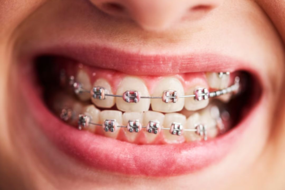 which braces give the most predictable results